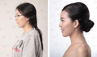 正畸如何吃瓜,轻松吃瓜，健康矫正两不误